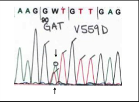 Figure 1. Sanger sequence showing a green (A) peak overlying a red (T) peak in KIT exon 11, indicating a mutation that changes codon 559 from a valine (V) to aspartic acid (D). This is a common mutation that is sensitive to imatinib. 